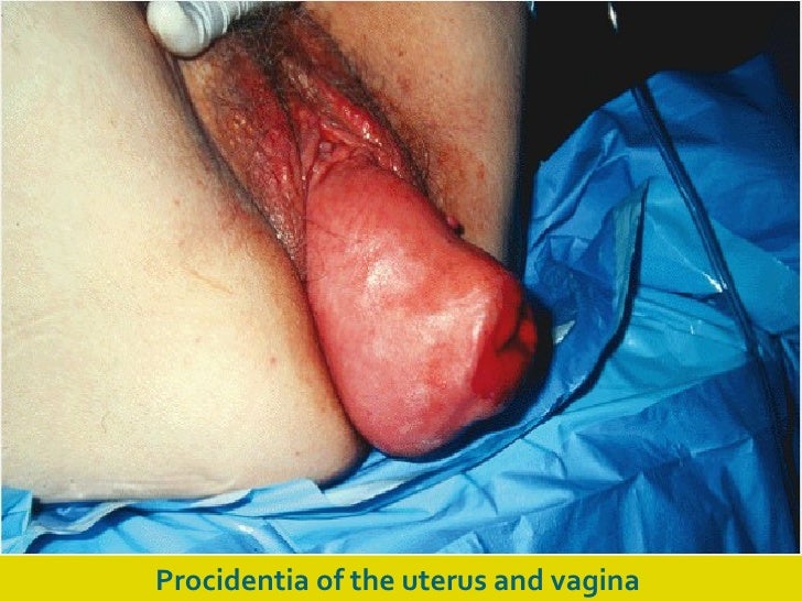 prolaps af uterus efter fødslen gratis porno hardcore prolaps af uterus efter fødslen gratis porno hardcore
