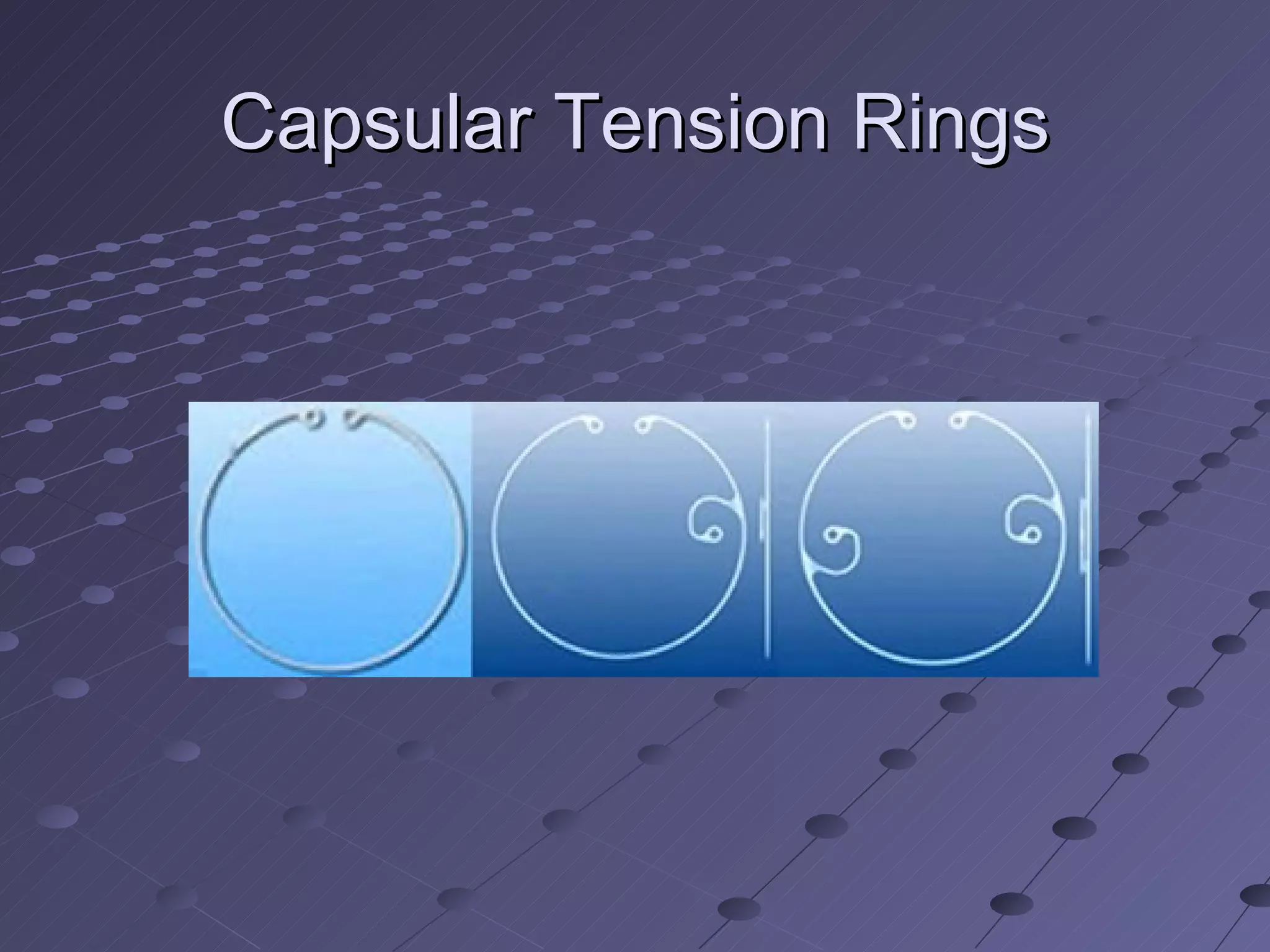 Capsular Tension Rings 