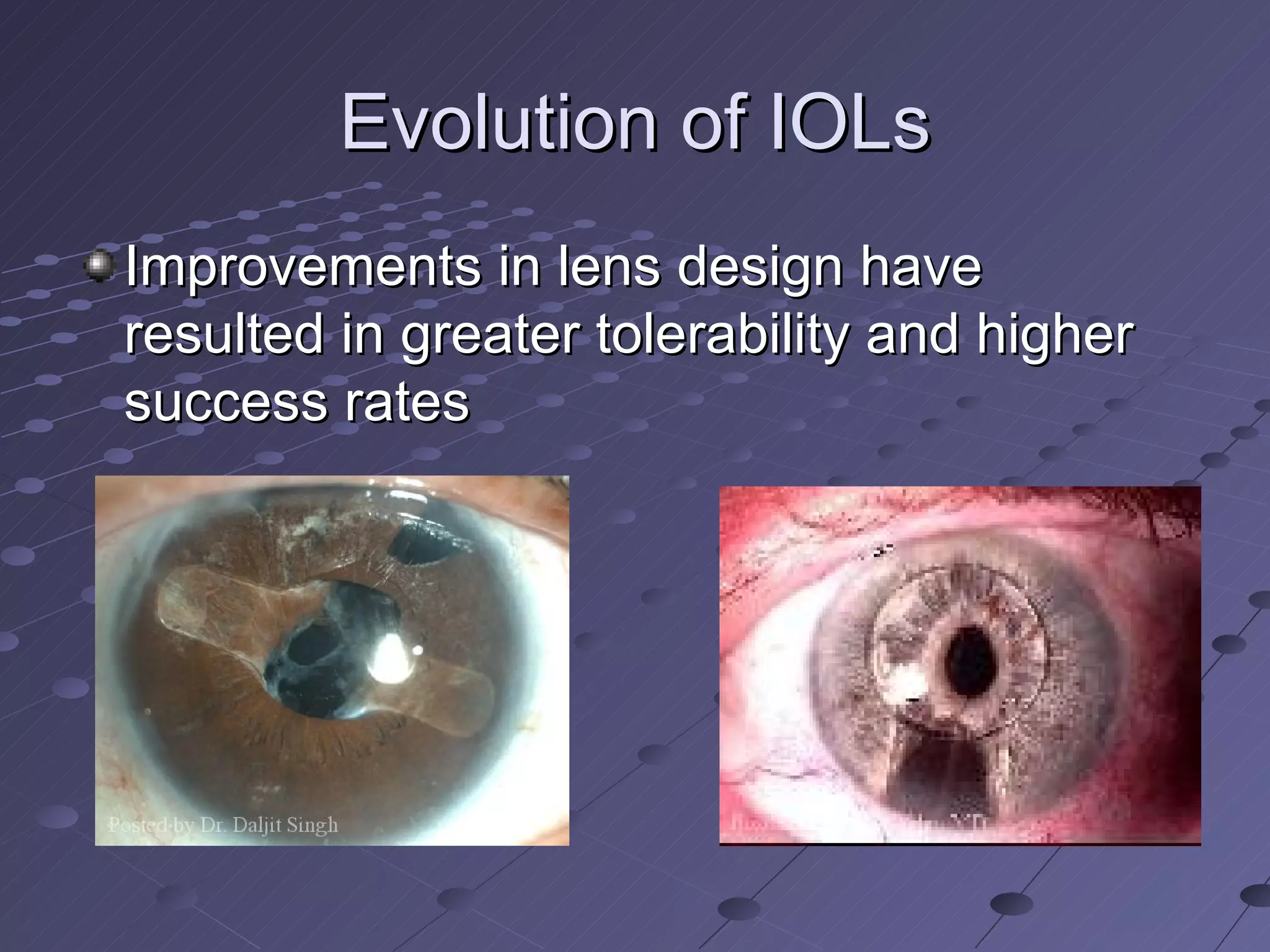 Evolution of IOLs Improvements in lens design have resulted in greater tolerability and higher success rates 