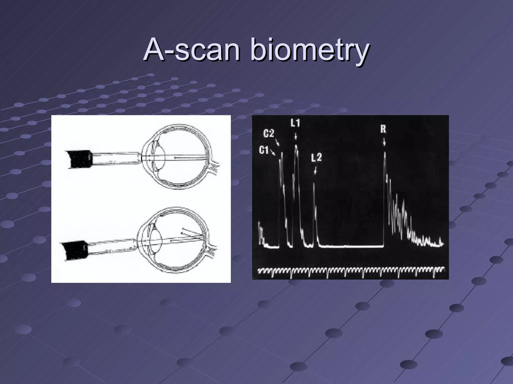 A-scan biometry 
