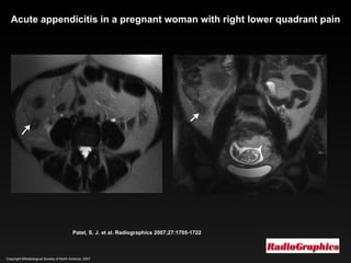 Copyright ©Radiological Society of North America, 2007 Patel, S. J. et al. Radiographics 2007;27:1705-1722 Acute appendicitis in a pregnant woman with right lower quadrant pain 