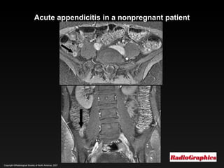 Copyright ©Radiological Society of North America, 2007 Acute appendicitis in a nonpregnant patient 