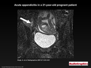 Copyright ©Radiological Society of North America, 2007 Singh, A. et al. Radiographics 2007;27:1419-1431 Acute appendicitis in a 21-year-old pregnant patient 