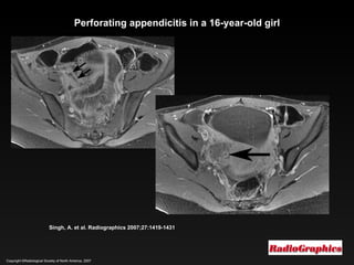 Copyright ©Radiological Society of North America, 2007 Singh, A. et al. Radiographics 2007;27:1419-1431 Perforating appendicitis in a 16-year-old girl 