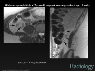 Copyright ©Radiological Society of North America, 2006 Pedrosa, I. et al. Radiology 2006;238:891-899 Mild acute appendicitis in a 27-year-old pregnant woman (gestational age, 13 weeks) 