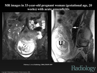 Copyright ©Radiological Society of North America, 2006 Pedrosa, I. et al. Radiology 2006;238:891-899 MR images in 33-year-old pregnant woman (gestational age, 20 weeks) with acute appendicitis 
