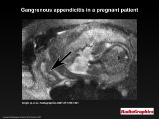 Copyright ©Radiological Society of North America, 2007 Singh, A. et al. Radiographics 2007;27:1419-1431 Gangrenous appendicitis in a pregnant patient 
