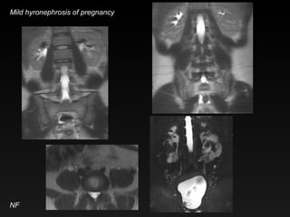 NF Mild hyronephrosis of pregnancy 