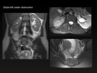 Distal left ureter obstruction 