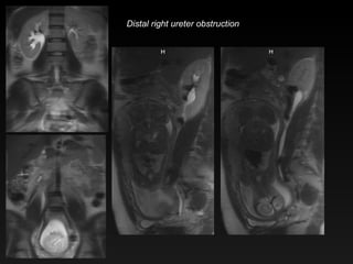 Distal right ureter obstruction 