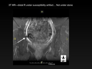 3T MR—distal R ureter susceptibility artifact… Not ureter stone 