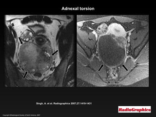 Copyright ©Radiological Society of North America, 2007 Singh, A. et al. Radiographics 2007;27:1419-1431 Adnexal torsion 