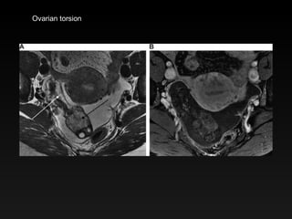 Ovarian torsion 