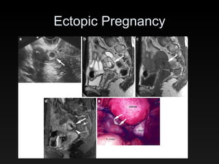 Ectopic Pregnancy 