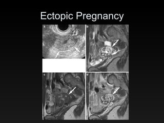 Ectopic Pregnancy 