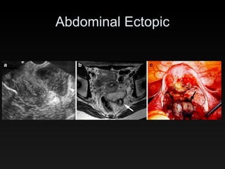 Abdominal Ectopic 