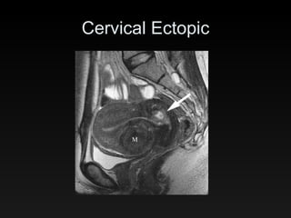 Cervical Ectopic 