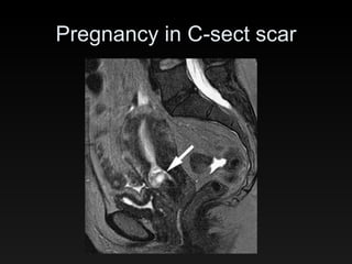 Pregnancy in C-sect scar 