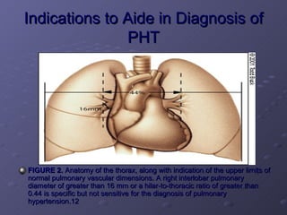 Pulmonary Hypertension 1 | PPT
