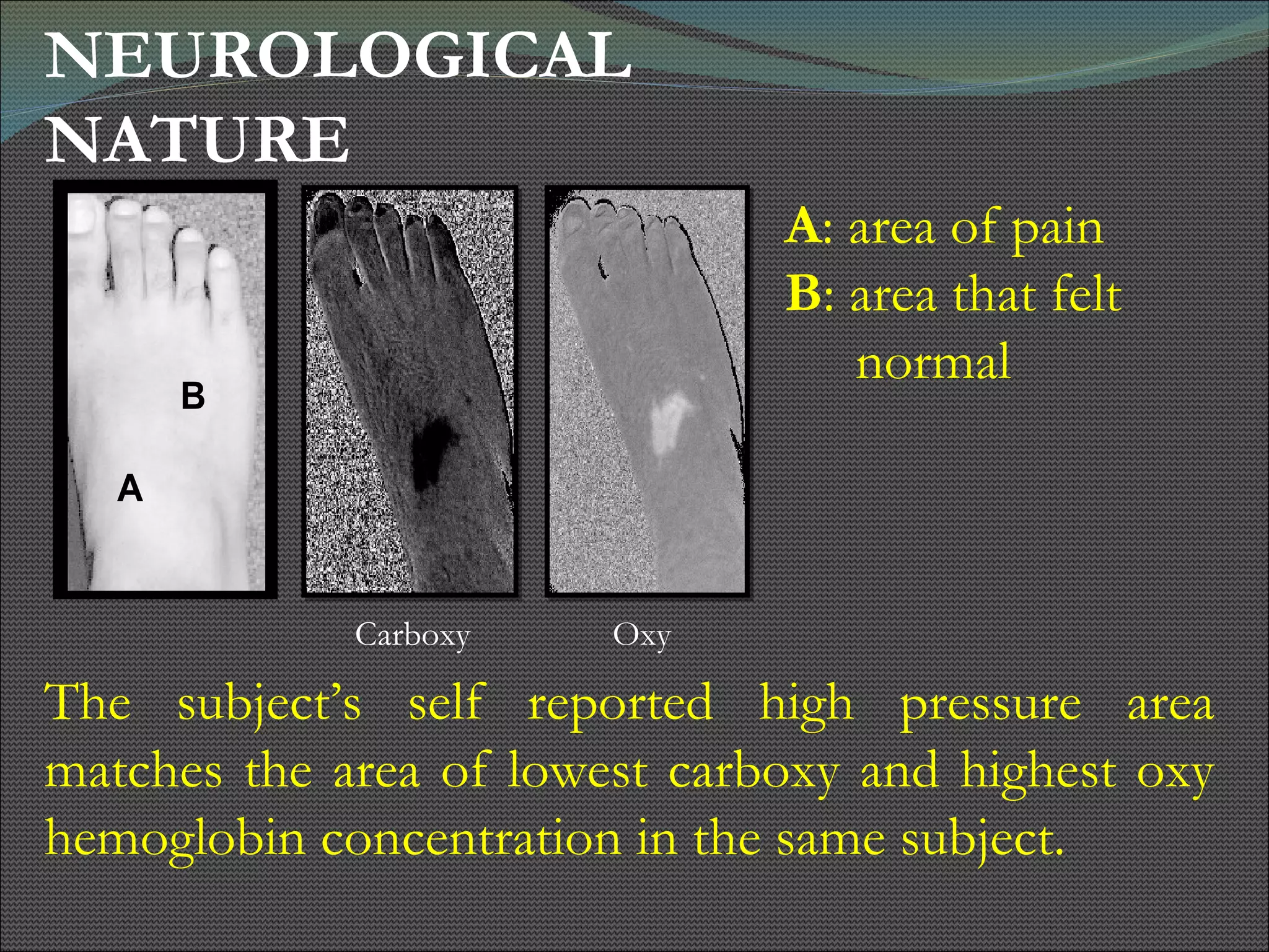 NEUROLOGICAL NATURE  The subject’s self reported high pressure area matches the area of lowest carboxy and highest oxy hemoglobin concentration in the same subject. A : area of pain B : area that felt  normal Carboxy  Oxy 