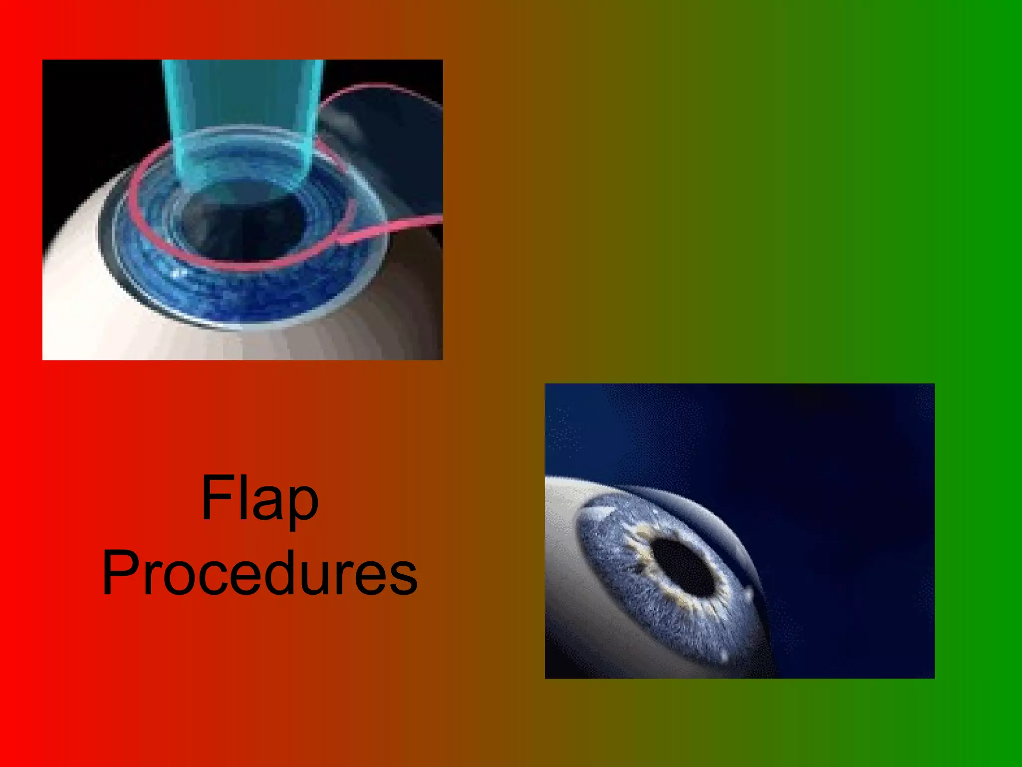 Flap Procedures 