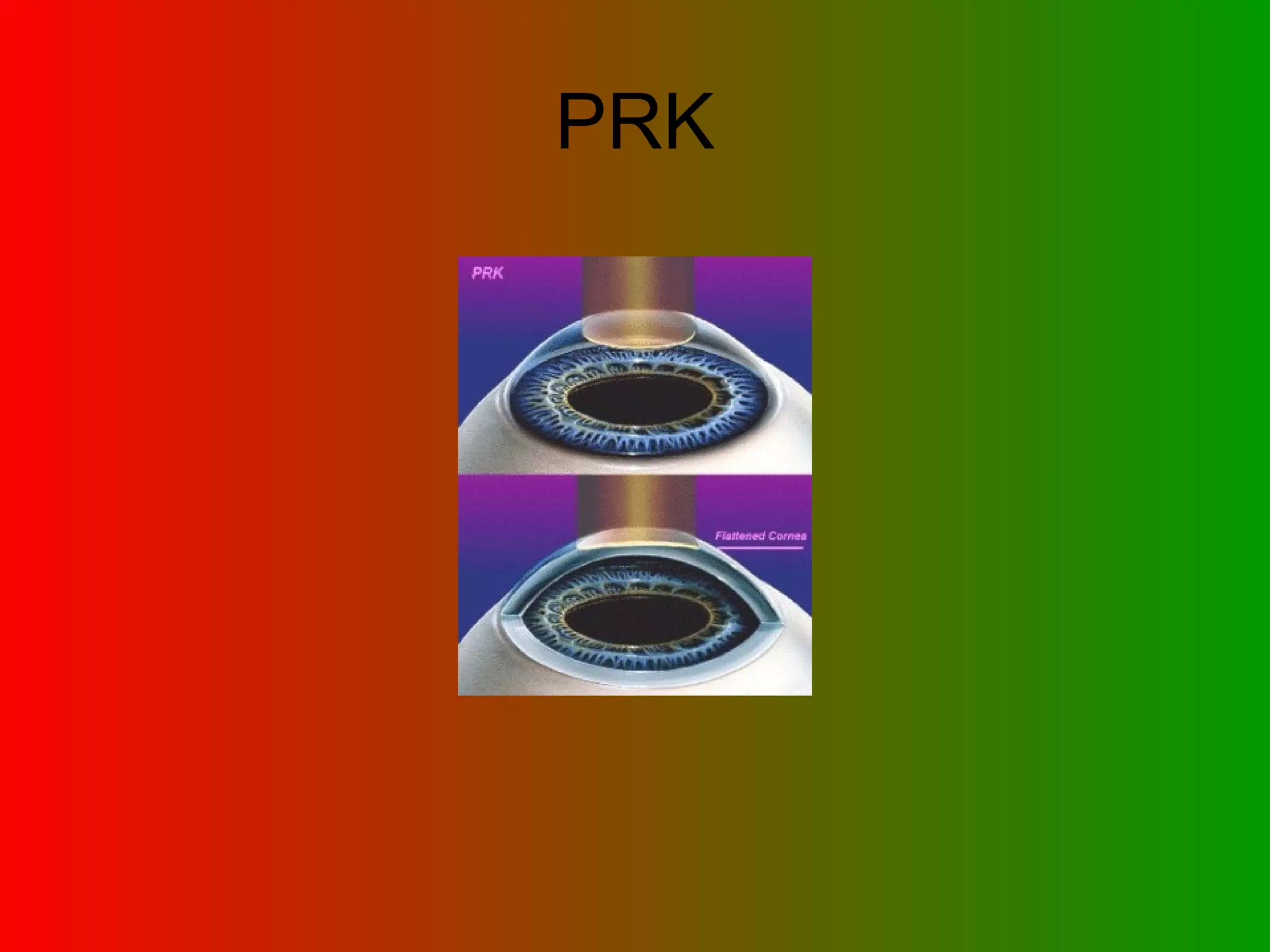 PRK 