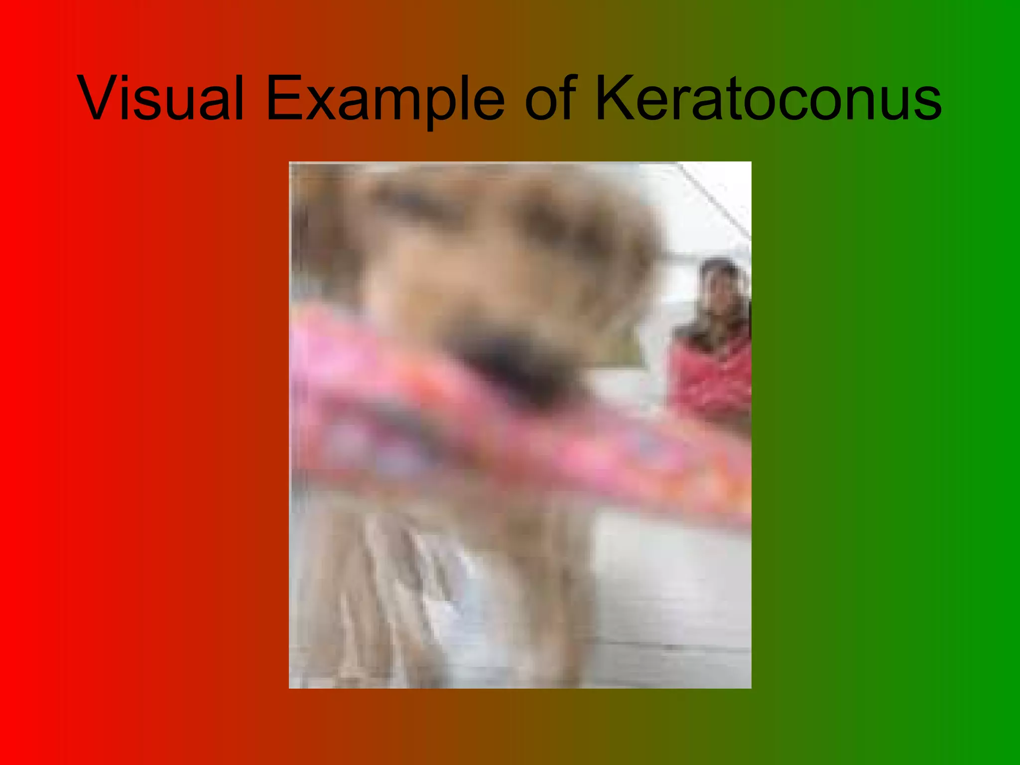 Visual Example of Keratoconus 