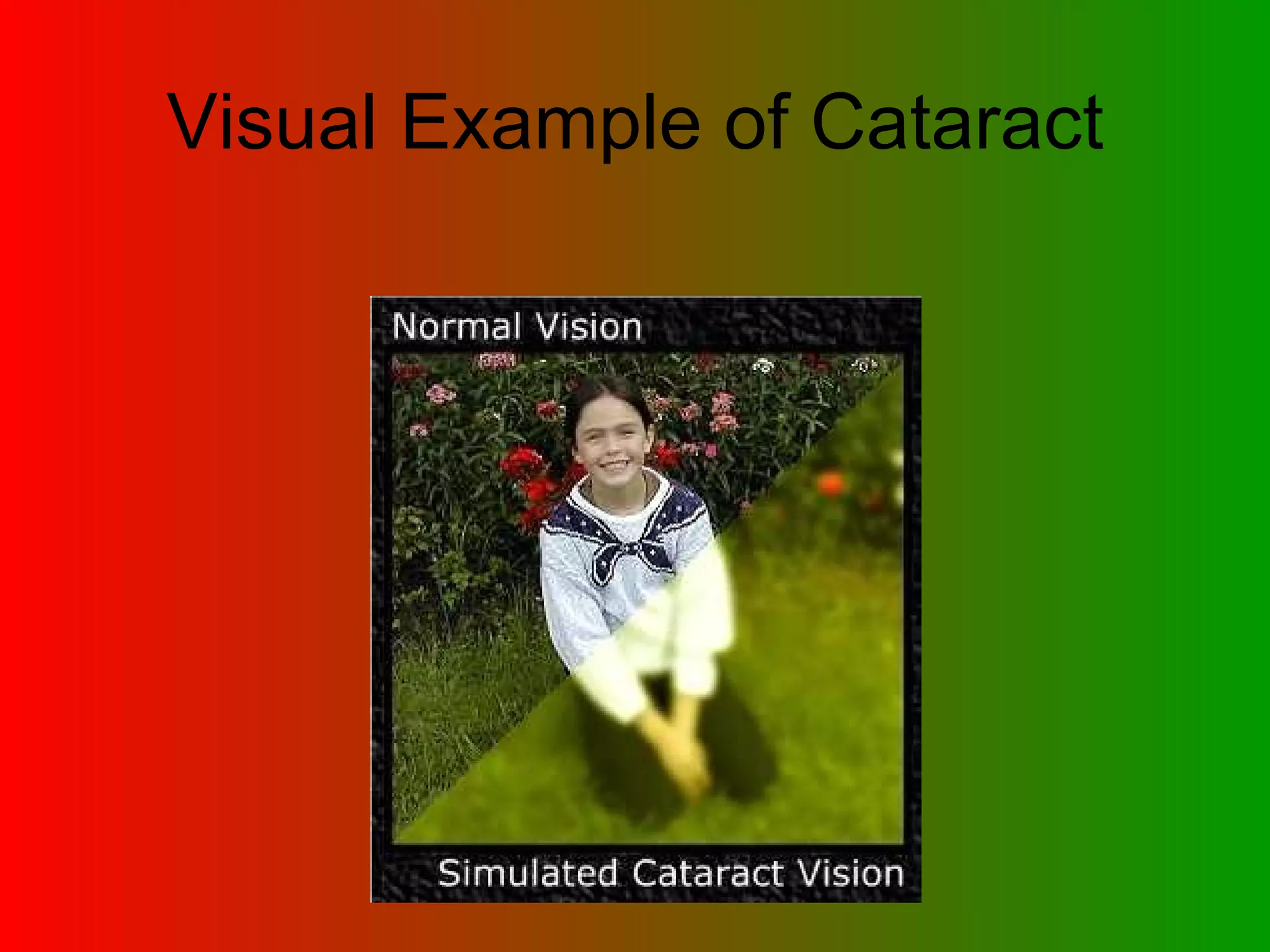 Visual Example of Cataract 