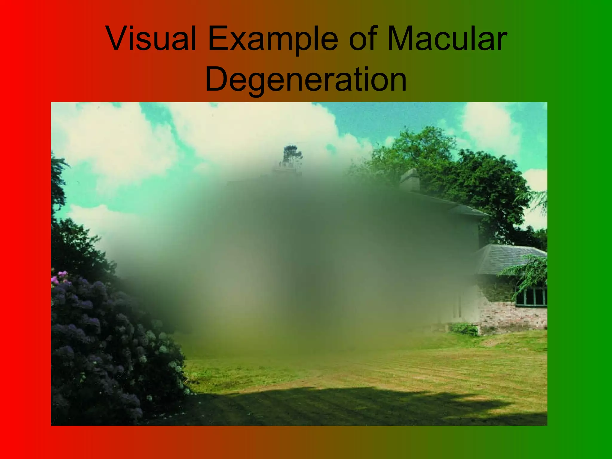 Visual Example of Macular Degeneration 