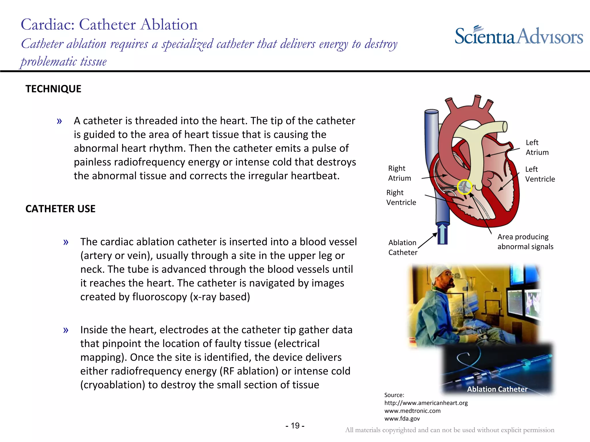 All materials copyrighted and can not be used without explicit permission
- 19 -
Cardiac: Catheter Ablation
Catheter ablation requires a specialized catheter that delivers energy to destroy
problematic tissue
TECHNIQUE
» A catheter is threaded into the heart. The tip of the catheter 
is guided to the area of heart tissue that is causing the 
abnormal heart rhythm. Then the catheter emits a pulse of 
painless radiofrequency energy or intense cold that destroys 
the abnormal tissue and corrects the irregular heartbeat.
CATHETER USE
» The cardiac ablation catheter is inserted into a blood vessel 
(artery or vein), usually through a site in the upper leg or 
neck. The tube is advanced through the blood vessels until 
it reaches the heart. The catheter is navigated by images 
created by fluoroscopy (x‐ray based)
» Inside the heart, electrodes at the catheter tip gather data 
that pinpoint the location of faulty tissue (electrical 
mapping). Once the site is identified, the device delivers 
either radiofrequency energy (RF ablation) or intense cold 
(cryoablation) to destroy the small section of tissue
Left 
Atrium
Left 
Ventricle
Right 
Atrium
Right 
Ventricle
Area producing 
abnormal signalsAblation 
Catheter
Source:
http://www.americanheart.org
www.medtronic.com
www.fda.gov
Ablation Catheter
 