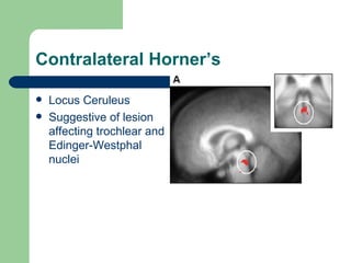 Contralateral Horner’s Locus Ceruleus Suggestive of lesion affecting trochlear and Edinger-Westphal nuclei 