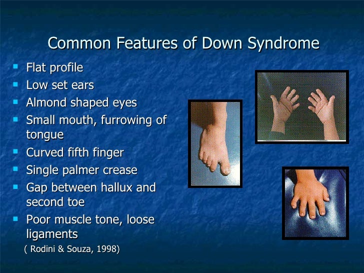 down syndrome features