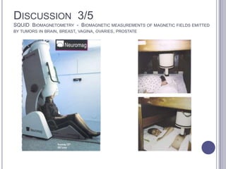 DISCUSSION 3/5
SQUID BIOMAGNETOMETRY - BIOMAGNETIC MEASUREMENTS OF MAGNETIC FIELDS EMITTED
BY TUMORS IN BRAIN, BREAST, VAGINA, OVARIES, PROSTATE
 