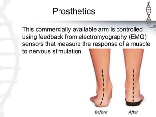 Prosthetics
This commercially available arm is controlled
using feedback from electromyography (EMG)
sensors that measure the response of a muscle
to nervous stimulation.
 