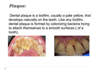 Plaque:
Dental plaque is a biofilm, usually a pale yellow, that
develops naturally on the teeth. Like any biofilm,
dental plaque is formed by colonizing bacteria trying
to attach themselves to a smooth surfaces ( of a
tooth).
 