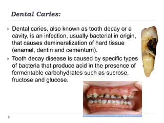 Dental Caries:
 Dental caries, also known as tooth decay or a
cavity, is an infection, usually bacterial in origin,
that causes demineralization of hard tissue
(enamel, dentin and cementum).
 Tooth decay disease is caused by specific types
of bacteria that produce acid in the presence of
fermentable carbohydrates such as sucrose,
fructose and glucose.
 