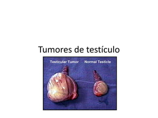 Tumores de testículo
 