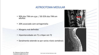 • 90% dos TIM em cças / 30-35% dos TIM em
adultos
• 20% associado com seringomielia
• Margens mal definidas
• Hipointensidade em T1 e Hiper em T2
• Geralmente extende-se por varios níveis vertebrais
ASTROCITOMA MEDULAR
Dr. Peterson Xavier da Silva
medpeterson@hotmail.com
TRATADO NEUROCIRURGIA SBN
 
