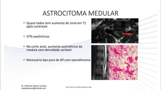 • Quase todos tem aumento de sinal em T1
após contraste
• 57% excêntricos
• No corte axial, aumento assimétrico da
medula com densidade variável
• Necessária bpx para dx dif com ependimoma
ASTROCITOMA MEDULAR
Dr. Peterson Xavier da Silva
medpeterson@hotmail.com
TRATADO NEUROCIRURGIA SBN
 