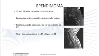 EPENDIMOMA
• 3º e 4º décadas, cervical e cervicotorácica
• Frequentemente associado a siringomielia e cistos
• Escoliose, erosão pedicular e do corpo vertebral ao
RX
• Sinal Hipo ou isointenso em T1 e Hiper em T2
Dr. Peterson Xavier da Silva
medpeterson@hotmail.com
TRATADO NEUROCIRURGIA SBN
 
