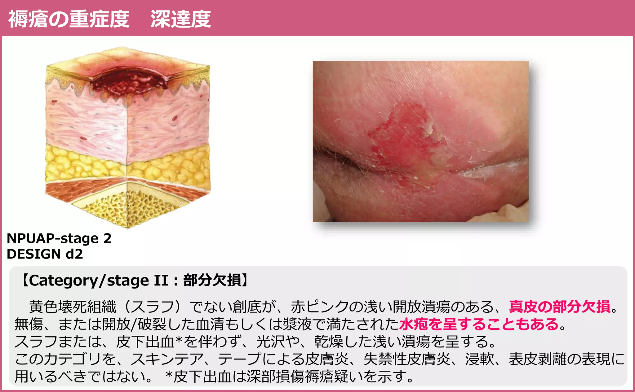 褥瘡の評価と実践 Assessment & Practice of Pressure Ulcer | PDF | Sk…