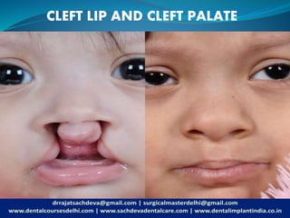 CLEFT LIP AND CLEFT PALATE
 