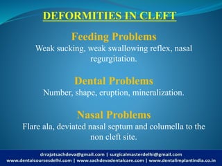 Cleft lip/Cleft Palate | Cleft Lip, Cleft Palate: What is a cleft lip ...