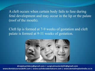 Cleft lip/Cleft Palate | Cleft Lip, Cleft Palate: What is a cleft lip ...