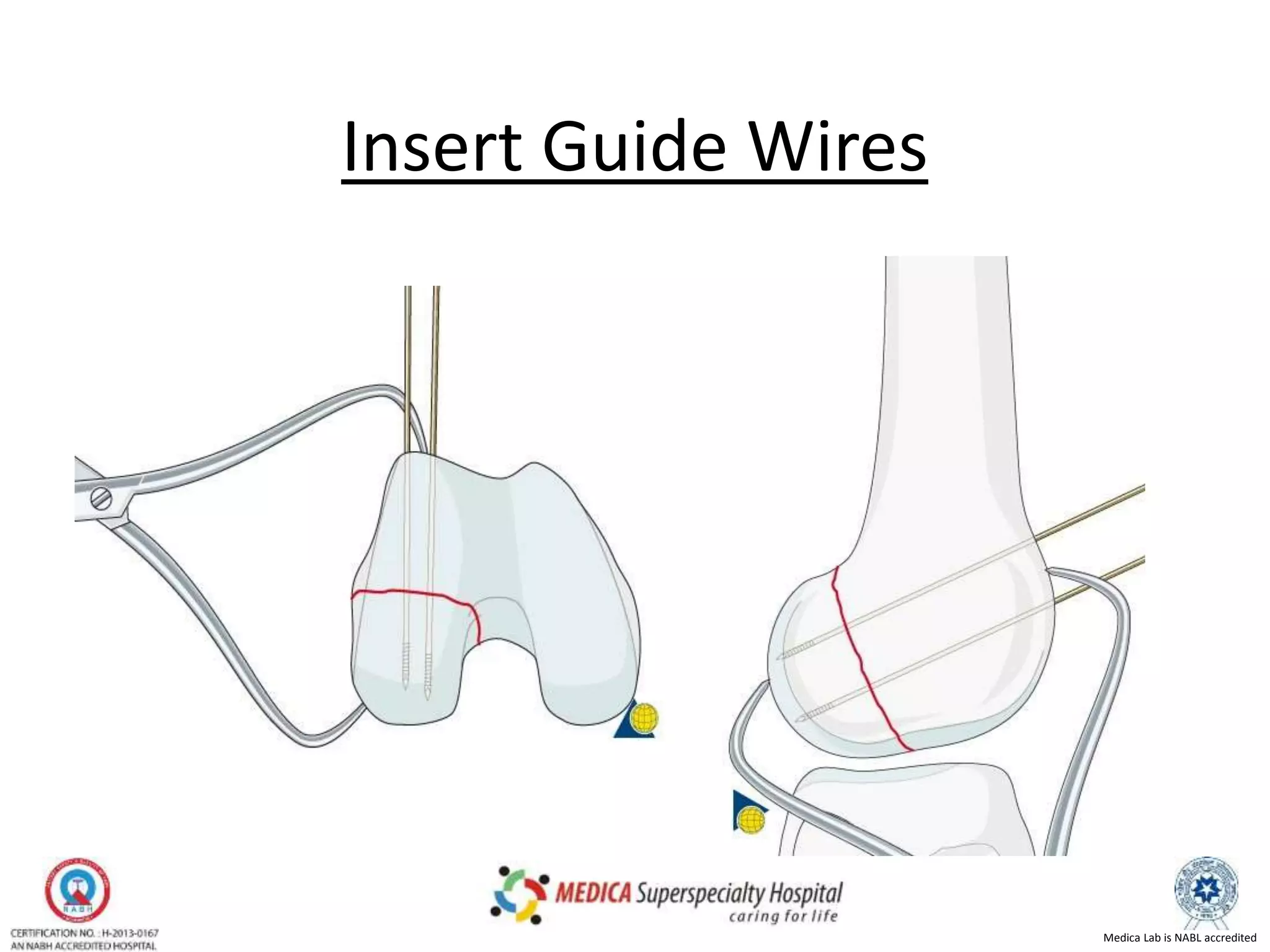 Medica Lab is NABL accredited
Insert Guide Wires
 