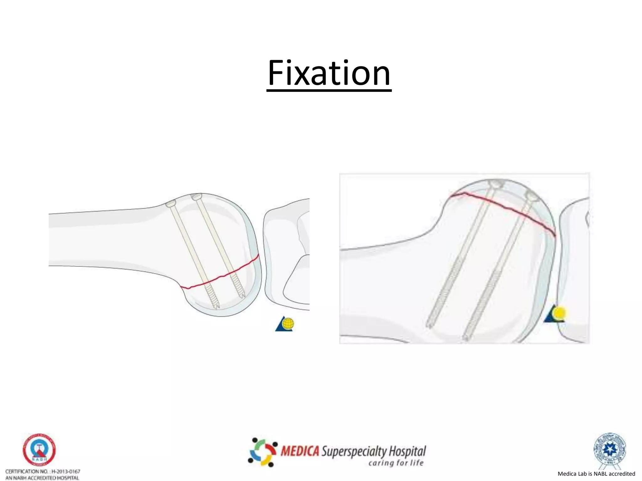 Medica Lab is NABL accredited
Fixation
 