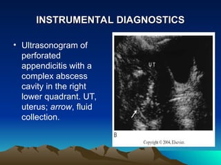 Acute appendicitis and complication. .ppt