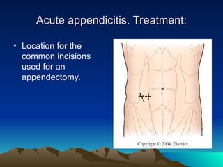Acute appendicitis and complication. .ppt