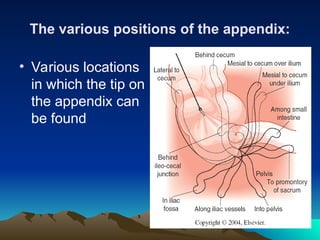 Acute appendicitis and complication. .ppt