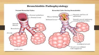 acute bronchiolitis in children presentation | PPTX